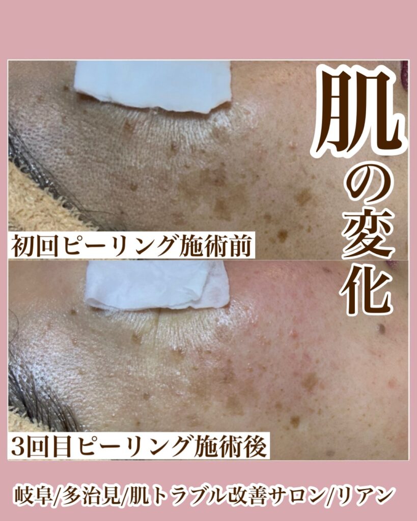 多治見 ｜毛穴・肌悩みに寄り添うフェイシャル専門店-lien-