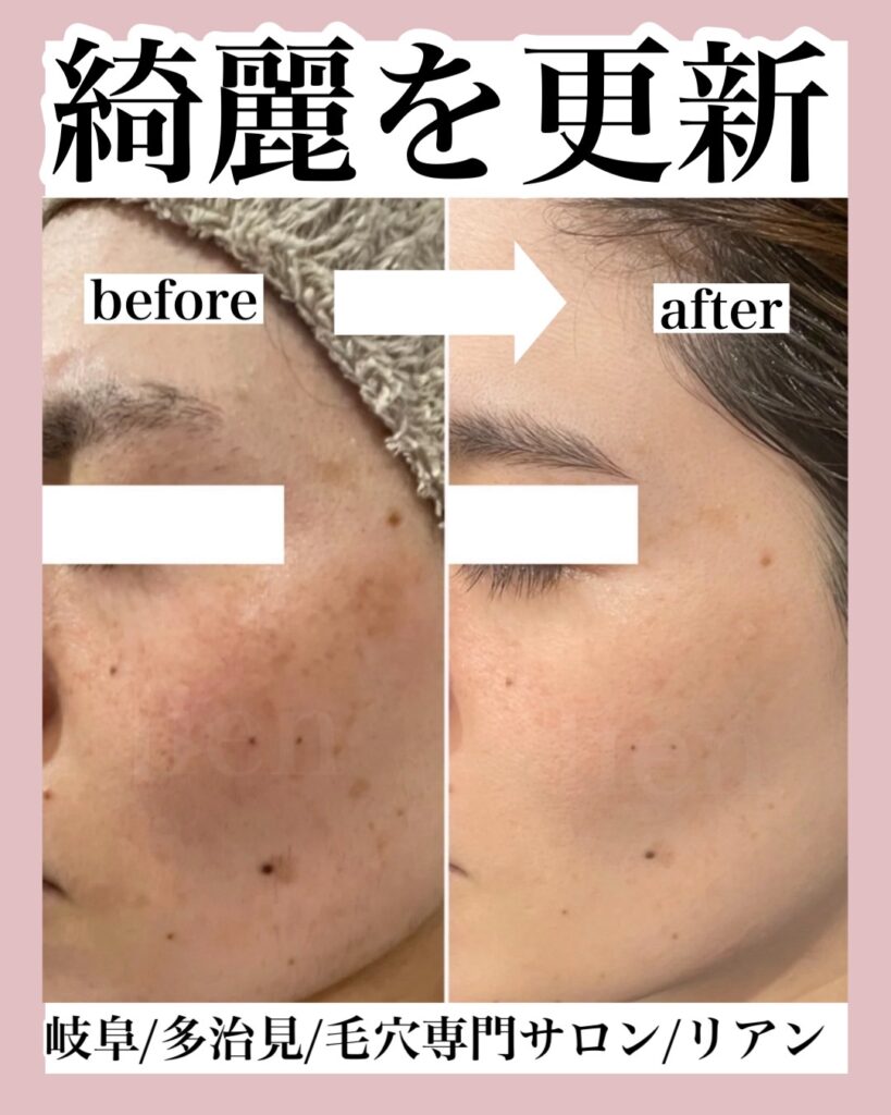 多治見 ｜毛穴・肌悩みに寄り添うフェイシャル専門店-lien-
