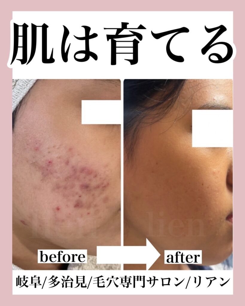 多治見 ｜毛穴・肌悩みに寄り添うフェイシャル専門店-lien-