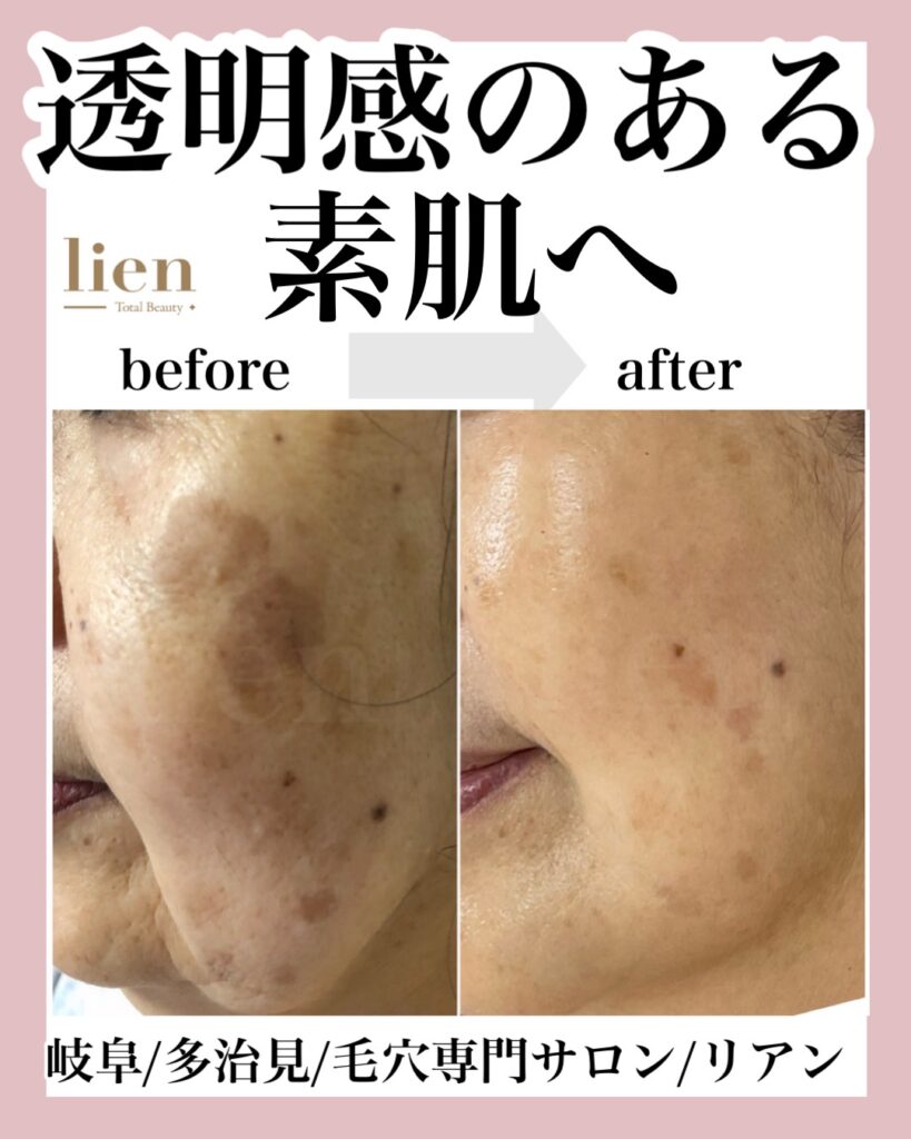 多治見 ｜毛穴・肌悩みに寄り添うフェイシャル専門店-lien-