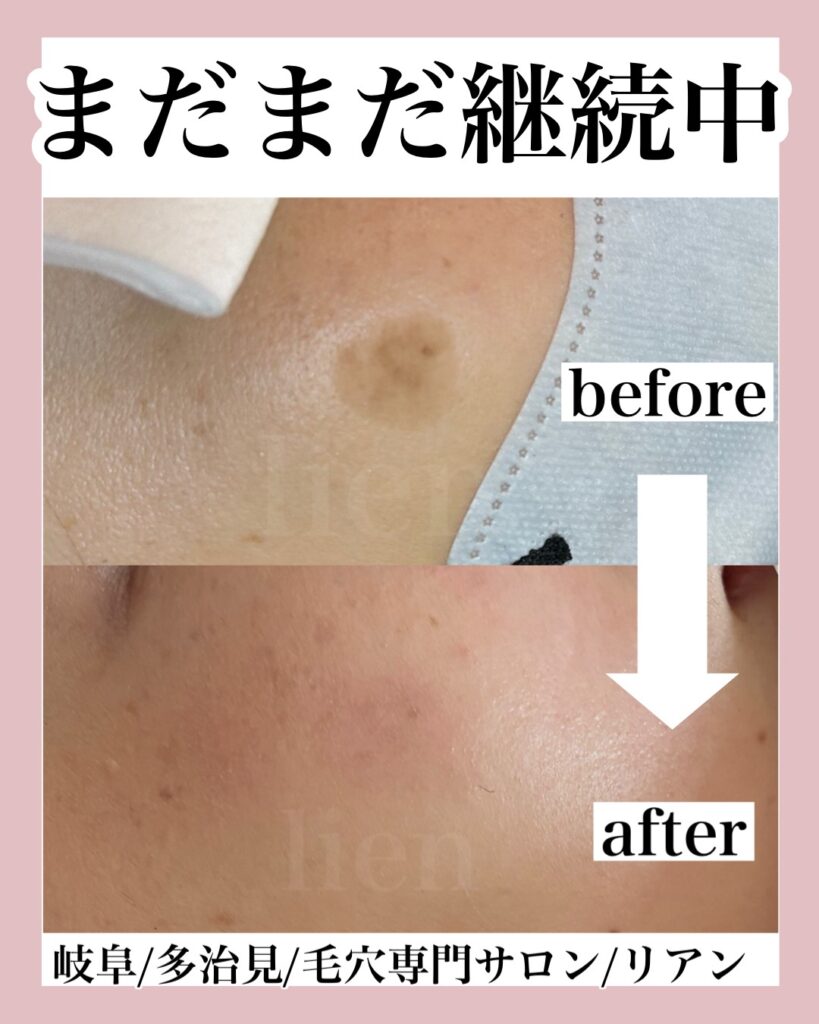 多治見 ｜毛穴・肌悩みに寄り添うフェイシャル専門店-lien-